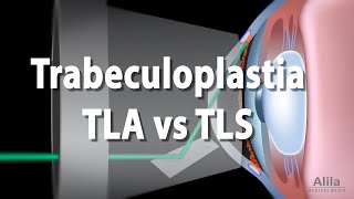 Trabeculoplastia Animación Alila Medical Media Español [upl. by Aerdnu]