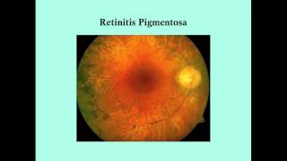 Retinitis Pigmentosa  CRASH Medical Review Series [upl. by Obala]