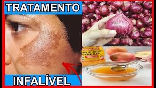 👉🏽MELASMA TRATAMENTO INFALÍVEL com CEBOLA ROXA e VINAGRE DE MAÇÃ [upl. by Ertnod]