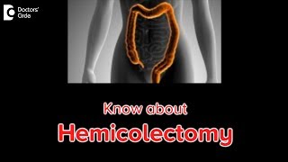 What is a Hemicolectomy Why is it done  Dr Rajasekhar M R [upl. by Mckinney677]