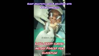 Zygomatic arch fracture reduction with keens approach [upl. by Notnef520]