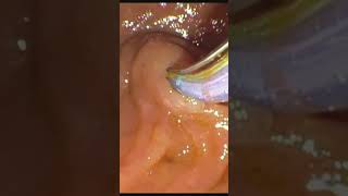 How to cannulate bile duct during ERCP [upl. by Ylicec]