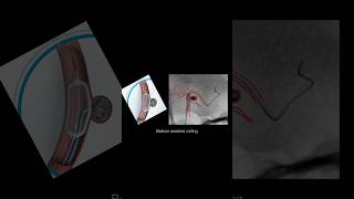 Brain aneurysm coiling  brain aneurysm treatment in Mumbai  Dr Dharav SAH [upl. by Alaric]