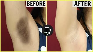 Lighten Dark Underarms NATURALLY amp PERMANENTLY  INSTANT Results  Miss Priya TV [upl. by Yngad]