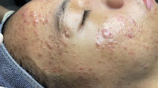 ACNE TREATMENT VU QUYNH MI  Perennial Blackheads On Boy Face 2024FULL [upl. by Caasi]