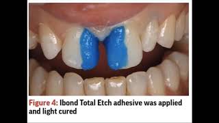 Diastema closure full case  A to Z [upl. by Demmer873]