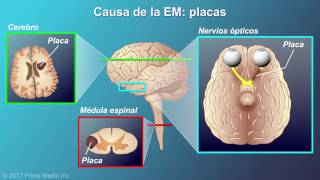 Explicación de la esclerosis múltiple [upl. by Yttig41]