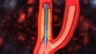 Carotid Artery Stenting video [upl. by Nos]