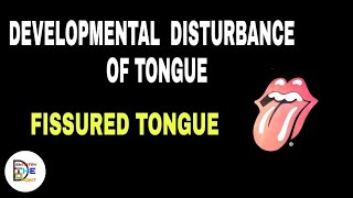 DEVELOPMENTAL DISTURBANCES OF TONGUE  FISSURED TONGUE [upl. by Notak]