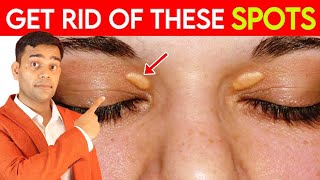 Get Rid Of These Spots  Fat Under Eyes  Xanthelasma  Natural Remedies  Dr Vivek Joshi [upl. by Alrzc115]