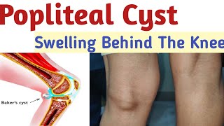 Popliteal cyst in the knee Swelling behind the knee knee pain bakers cyst Bakers cyst treatment [upl. by Mcclees]