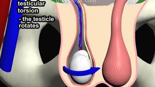 Testicular Torsion Animation by Cal Shipley MD [upl. by Ahsirtap672]