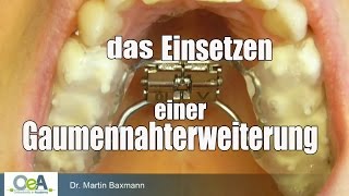 Gaumennahterweiterung einsetzen Rapid Maxillary Expansion I OeA [upl. by Ssepmet]