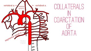 Coarctation of the Aorta  Infantile type amp Adult type [upl. by Llehcar]