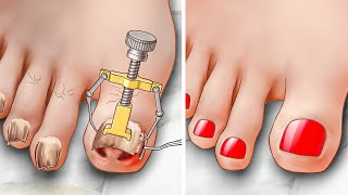 ASMR  내향성 발톱 제거 치료  Ingrown Toenail removal treatment animation [upl. by Debera]