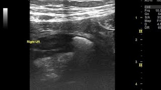 Hydronephrosis with hydroureter ureteral or ureteric calculus Ultrasound color Doppler video [upl. by Umont]