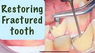 Tooth Fracture Restoration with composite amp fiber post [upl. by Orsa205]