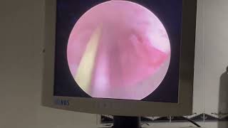 Urethral Stricture treated by DVIU [upl. by Airym]