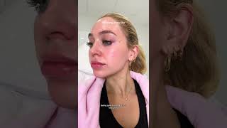 Dissolving my Lip Filler 💗 vlog lipfiller [upl. by Eatnuahc]