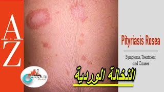 Pityriasis Rosea From A to Z  النخالة الوردية  اعراضها واسبابها  تطور المرض  كل اربعاء [upl. by Juliette765]