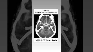 Subarachnoid Hemorrhage CT Scan viral youtubeshorts ct shortsfeed [upl. by Koloski]