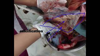 calcification of plecenta  midwifery nursingofficer mbbs education [upl. by Ecirtael11]