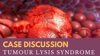 Case Discussion  Tumour Lysis Syndrome [upl. by Aja637]