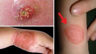 5 Home Remedies for Staph Infection on Skin  Cure Staph Infection Without Antibiotics [upl. by Sinnaiy48]