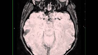 Craniopharyngioma papillary [upl. by Veron850]