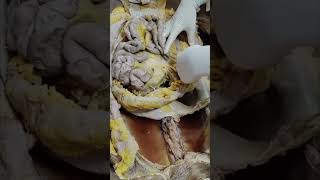 Detaching the loop of large intestine shorts anatomy dissection [upl. by Beetner]