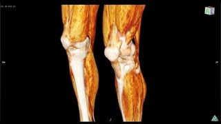 Legs patellar tendon 脚、膝蓋腱 volume rendering 3D CT [upl. by Liebman]