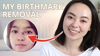 My Birthmark Nevus of Ota Removal – 6 Years Later [upl. by Snej117]