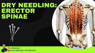 Dry Needling Erector Spinae [upl. by Sarkaria]