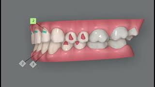 Invisalign Clincheck simulation Correction of deep bite and traumatic occlusion Delicate case [upl. by Nor]