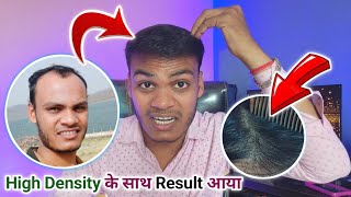 Hair Transplant Results Raipur Chhattisgarh amp Bhopal City Hair Transplant Me Kitna Kharcha Aata Hai [upl. by Rebecca]