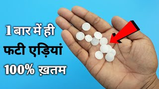 1 दिन में फटी एड़ियों से छुटकारा पाएं  Cracked heels Remedy amp crack heel treatment [upl. by Ahcilef]