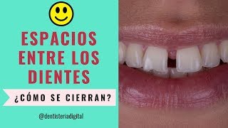 Espacios entre los dientes ¿Cómo cerrarlos Ortodoncia o Diseño de Sonrisa [upl. by Adnouqal]