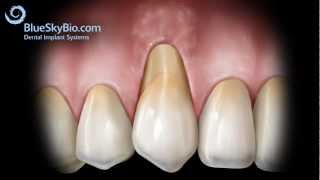 Patient Treatment Videos Gingival Graft Alloderm [upl. by Damaris]