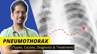 PNEUMOTHORAX Types Causes Diagnosis amp Treatment  Detailed video [upl. by Nekal846]