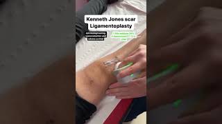 Winback Fascia tool on a Kenneth Jones scar ligamentoplasty [upl. by Lemej]