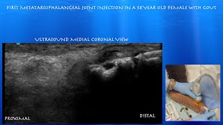 Ultrasound Guided First Metatarsophalangeal Joint Injection by probeultrasound [upl. by Nahtaneoj]