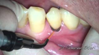 Sensibilità Dentale  Trattamento LASER Risolutivo [upl. by Navonod]