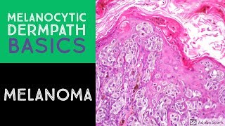 Melanocytic Dermpath Basics Melanoma [upl. by Cain]