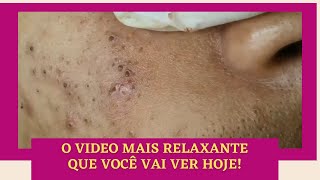 🌹Extração de Cravo Severo  Video Relaxante e Satisfatorio [upl. by Eibor]