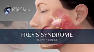 Freys Syndrome Information Prevention and Treatment Explained By Dr Ryan F Osborne [upl. by Ludovick]