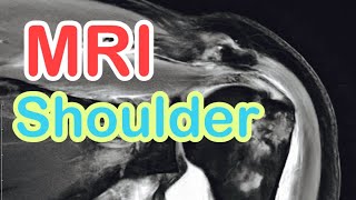 MRI For Shoulder [upl. by Salomo]