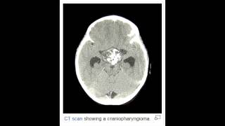 Craniopharyngioma  Derived from remnants of Rathkes Pouch [upl. by Nabala]