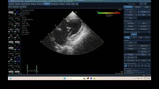 IQ 306 TSI TISSUE SYNCHRONY IMAGING ECHOPAC ANALYSIS ECHOCARDIOGRAPHY HEPATOMA PTE [upl. by Norraa]