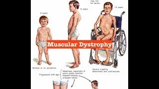 Muscular Dystrophy ꯃꯥꯁꯀꯨꯂꯥꯔ ꯗꯤꯁ꯭ꯇꯔꯣꯐꯤ [upl. by Icats]