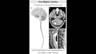 von HippelLindau disease dominant tumor suppressor gene mutation [upl. by Shirlee]